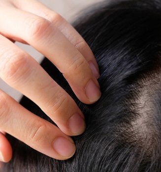 Hair Loss Signs Of Alopecia