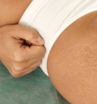 Best Makeup To Cover Stretch Marks