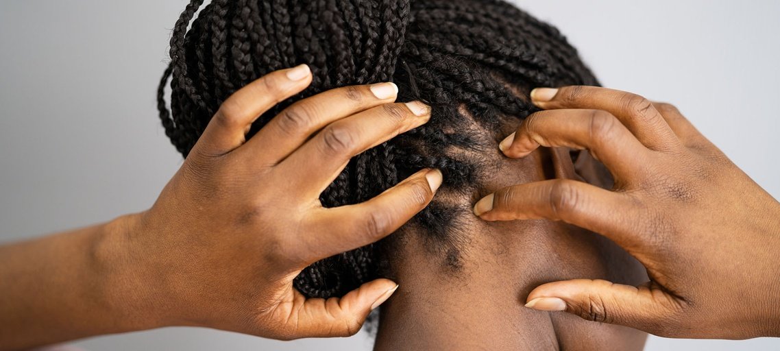 What Is Scalp Psoriasis