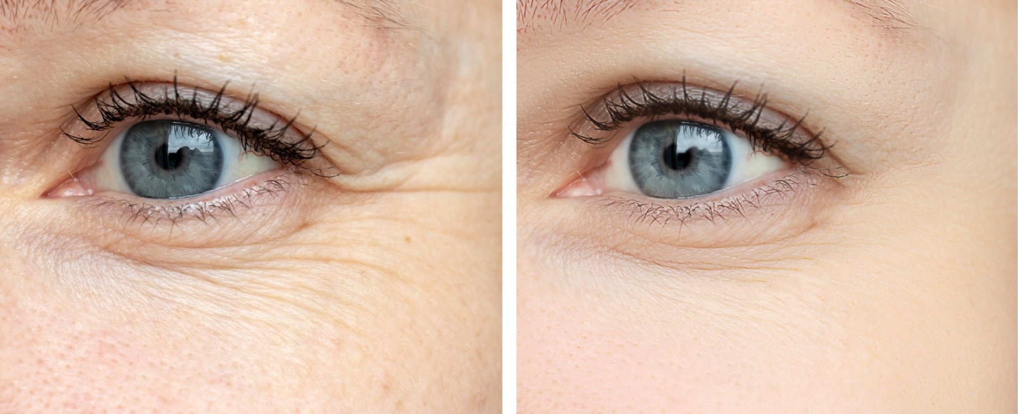 Tips to Prevent Creasing under Eyes: Expert Secrets Revealed
