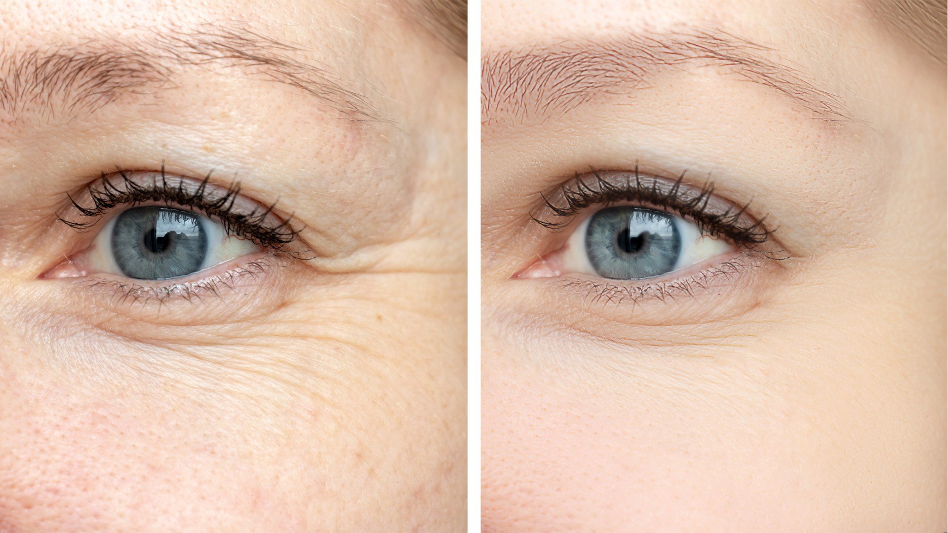 How to Manage Under-Eye Wrinkles and Lines - L’Oréal Paris