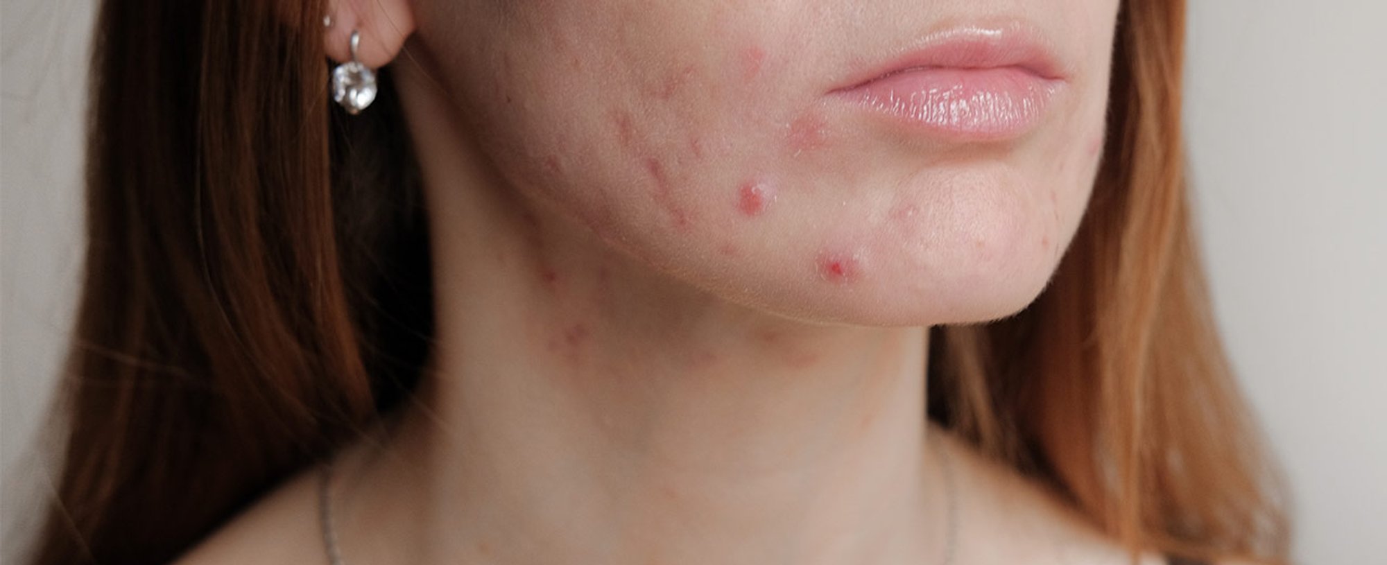 LOreal Paris BMAG Article What Are Blemishes D